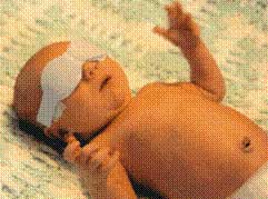Jaundice Baby with Phototherapy Mask